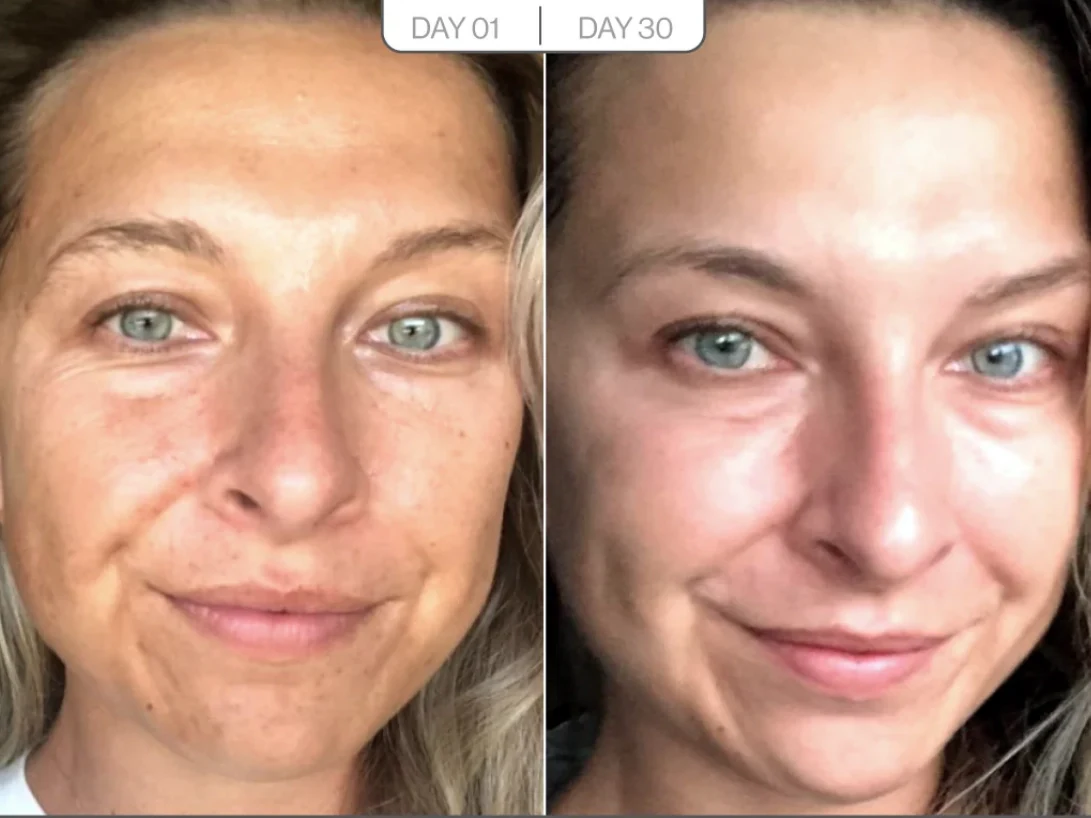 Sagging cheeks before and after result