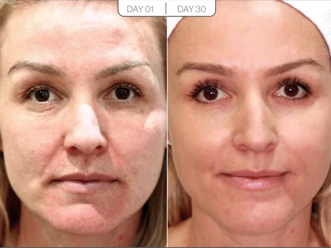 Fine lines before and after result