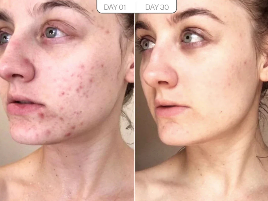 Neck firming before and after result