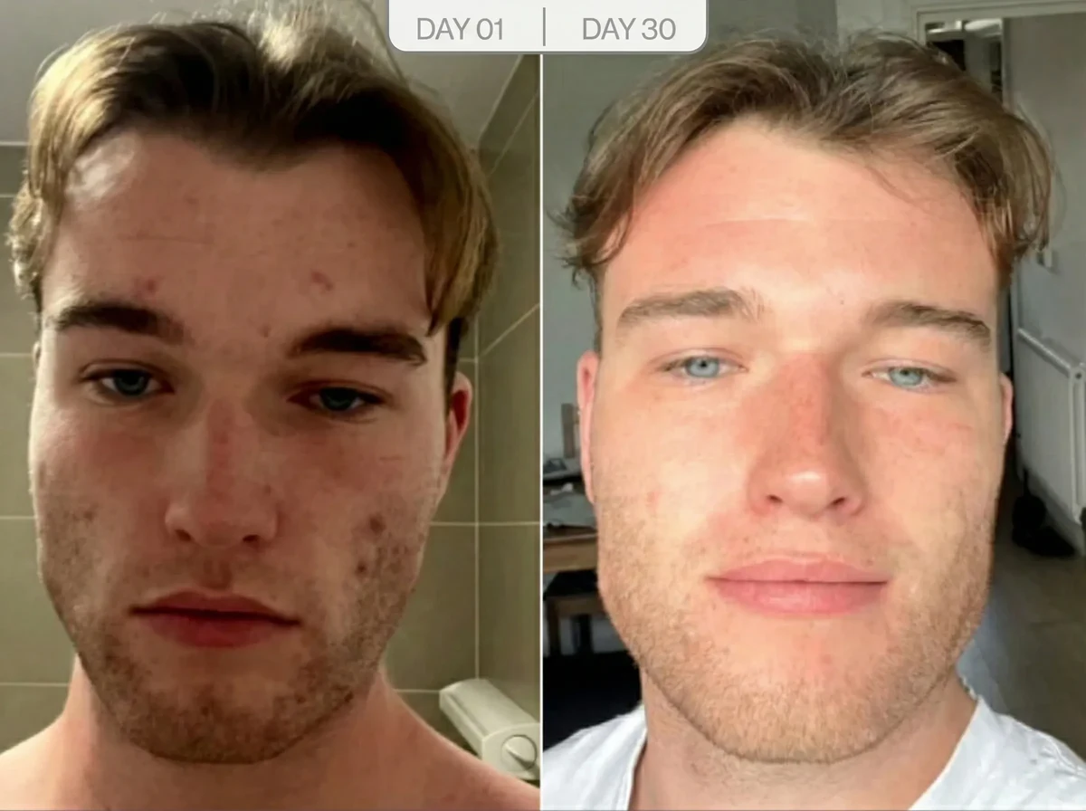 Jawline sculpting before and after result