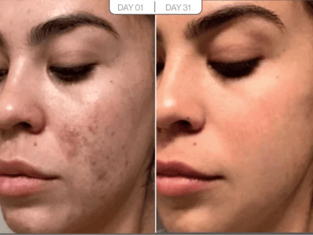 Skin texture before and after result